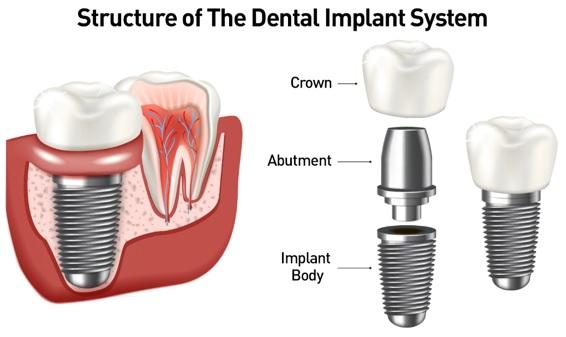 best dental implant clinic in 