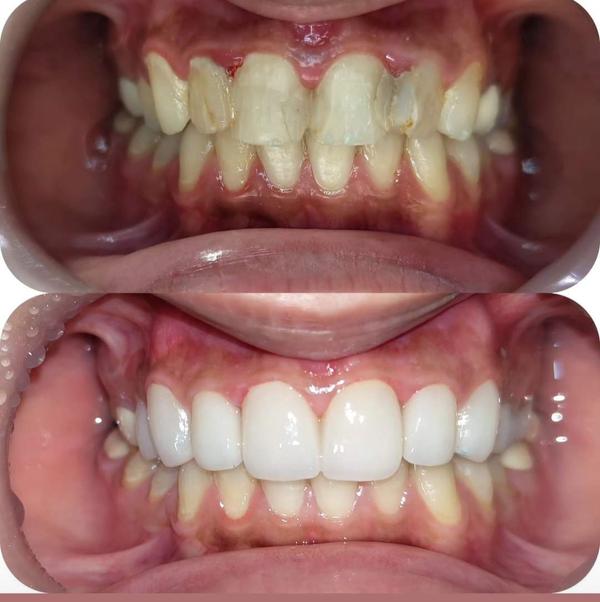 lower jaw forward