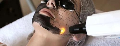 Laser Carbon Peel in Chennai for a Celeb