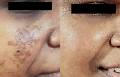 Melasma Treatment in Chennai for Clear S