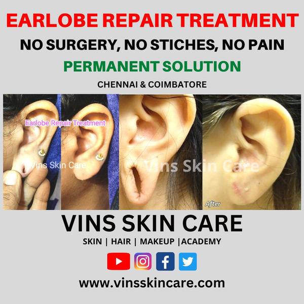 Earlobe Repair Treatment in Chennai for 