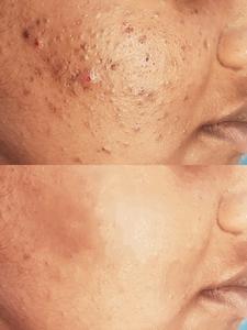 Acne Treatment in Chennai for Clear, Hea