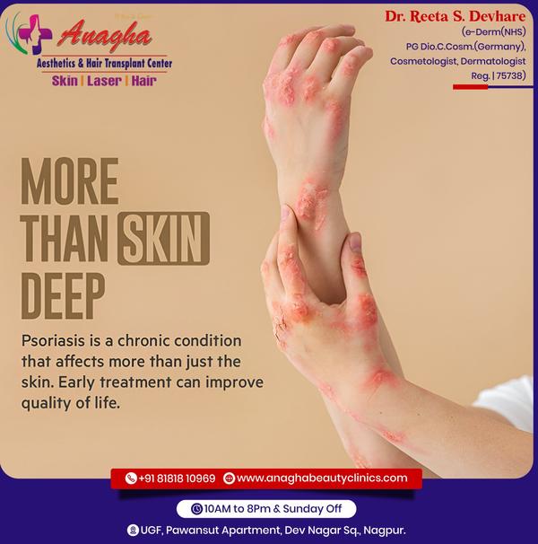 Best treatment on psoriasis in Anagha Ae