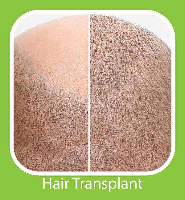 hair loss struggling