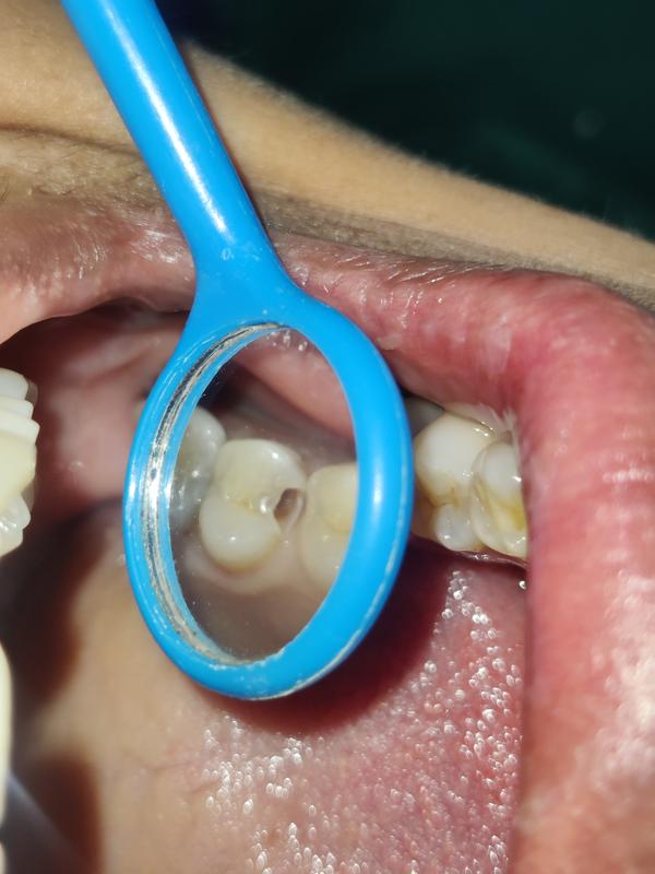 small cavity