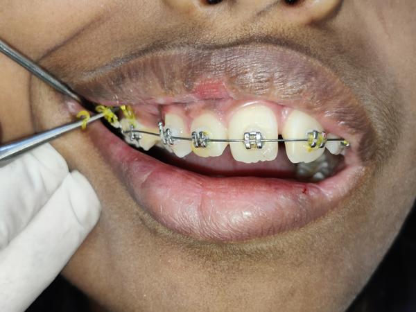 metal braces