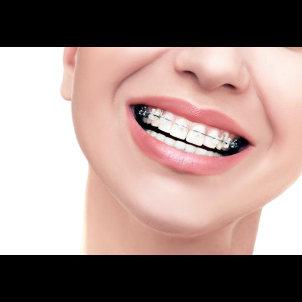 ceramic braces teens