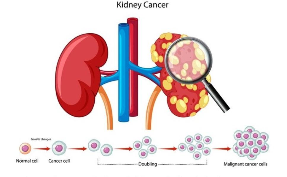 kidney cancer treatment mumbai