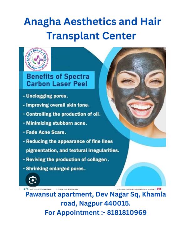 Best treatment on carbon peeling in Anag