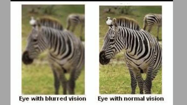 lazy eye amblyopia