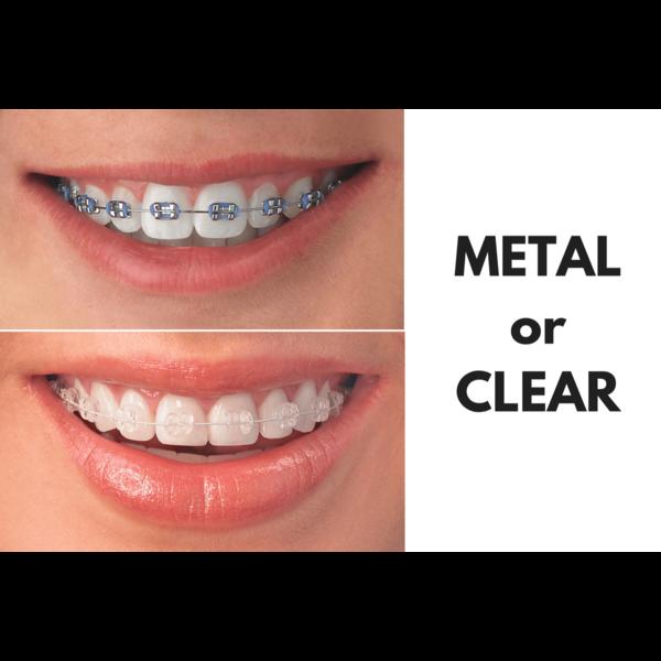 Braces Treatment in Jagatpura