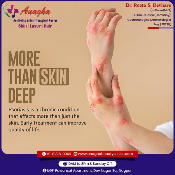 Best treatment on Skin Psoriasis In Anag