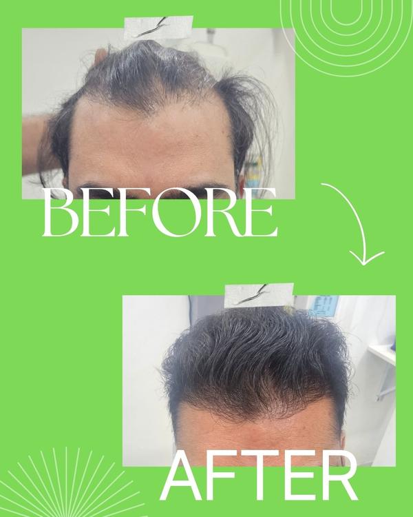 3in1 superfacial