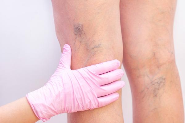 varicose veins ensuring