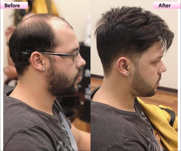 100 human remy hair patches