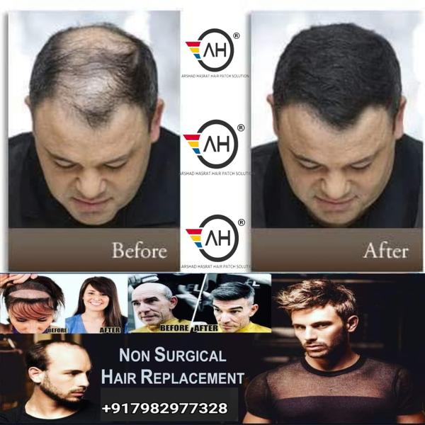 baldness permanent solution in