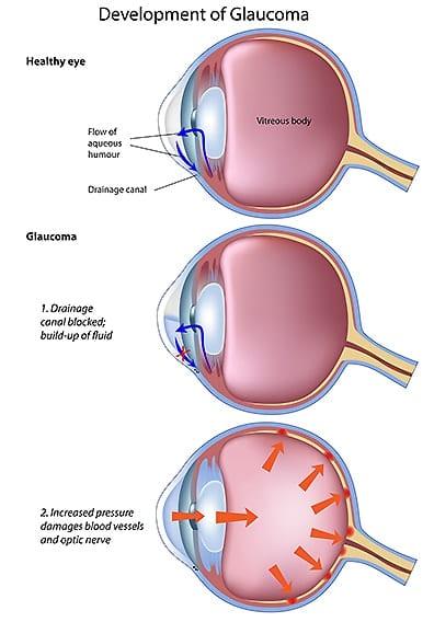 glaucoma glaucoma