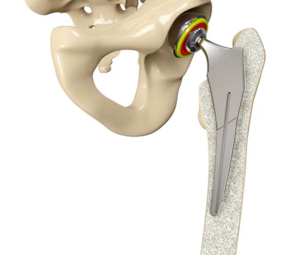 advanced implants