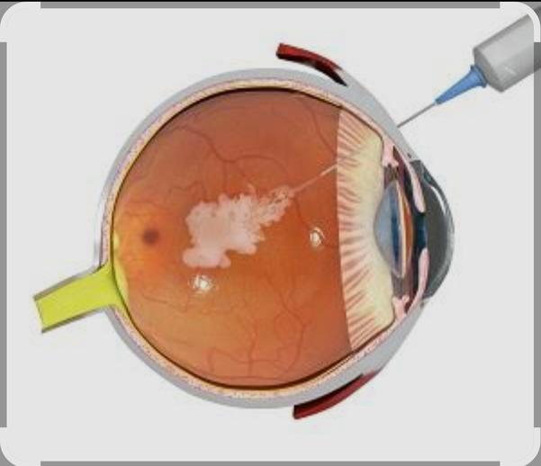 intravitreal injection