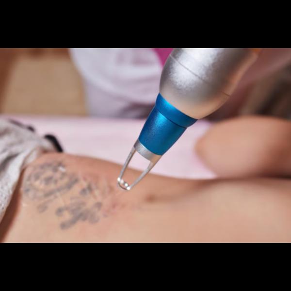 professional tattoo removal st