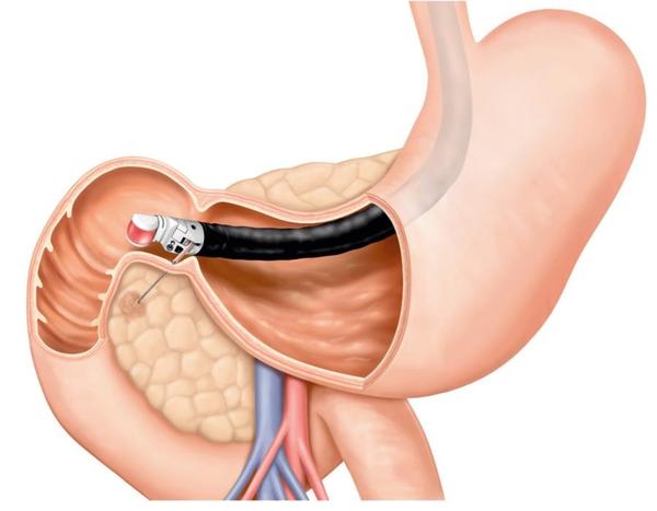 functional dyspepsia symptoms