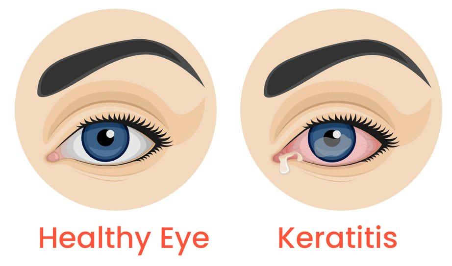keratitis keratitis