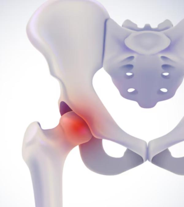 damaged hip joint