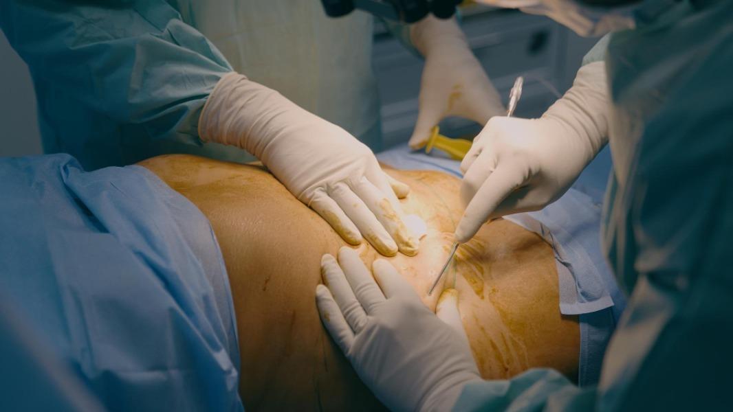 minimally invasive hernia repa