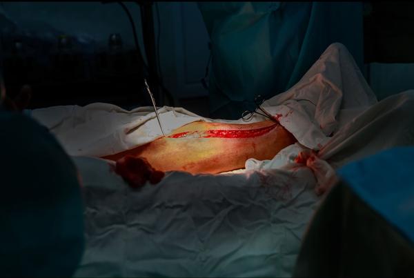 ventral hernia