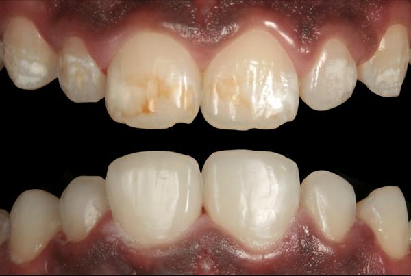 cover severe fluorosis