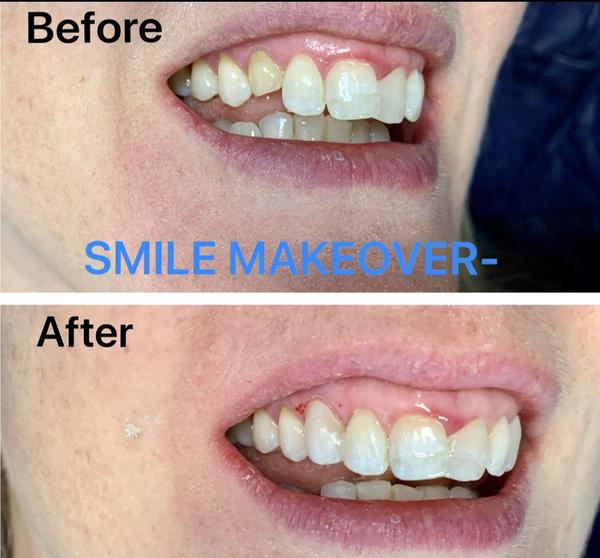 permanent tooth restoration ja