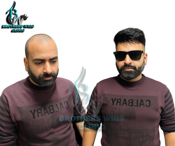 undetectable hair patch soluti