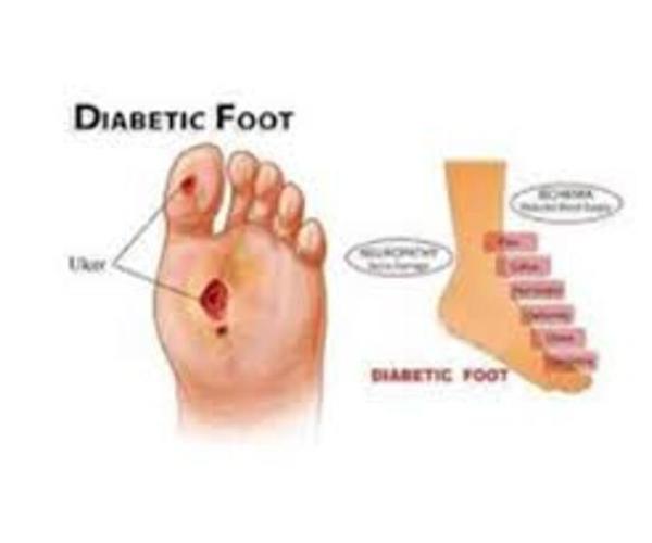 advanced diabetic wound healin