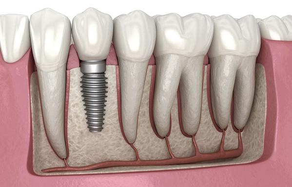 fda approved dental implants j