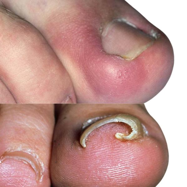 painless toenail surgery servi