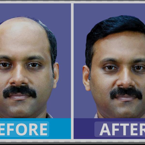Hair Patch Services Sector 49 Noida

Bes