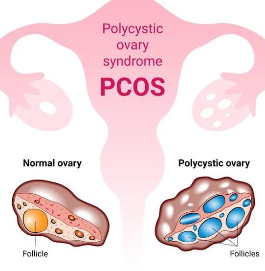 PCOS leads to obesity is a myt