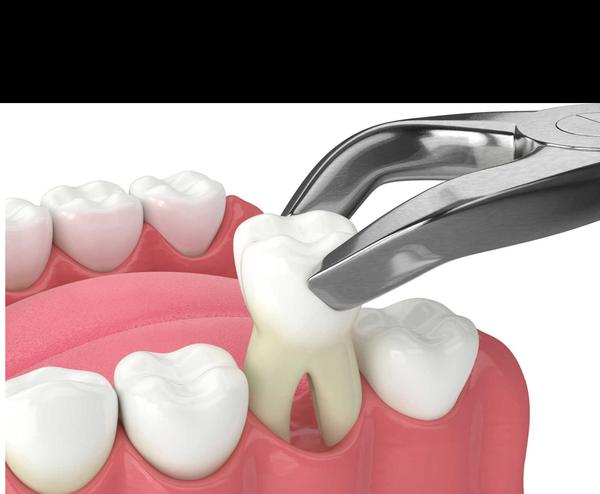 painless tooth extraction jaip