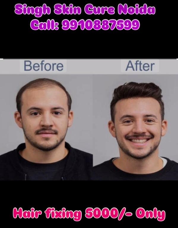 Best hair patch fixing clinic in Noida 
