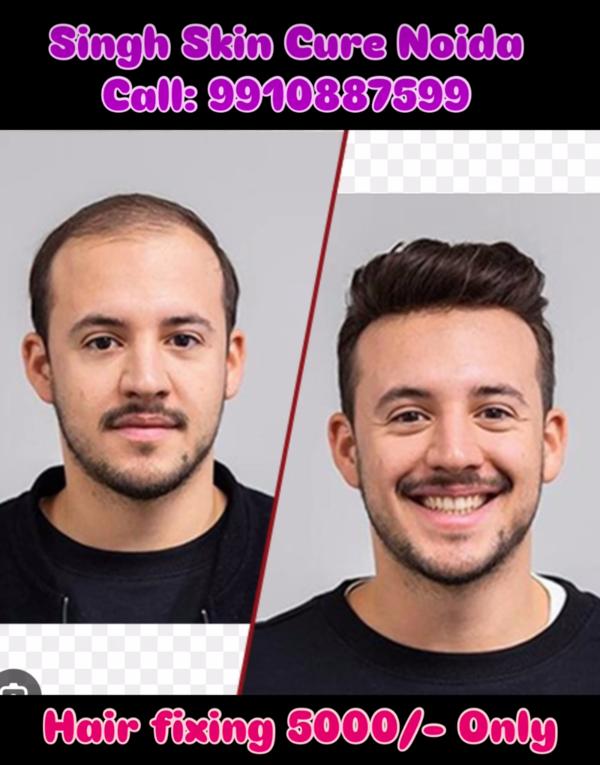 Best hair patch fixing clinic in Noida 
