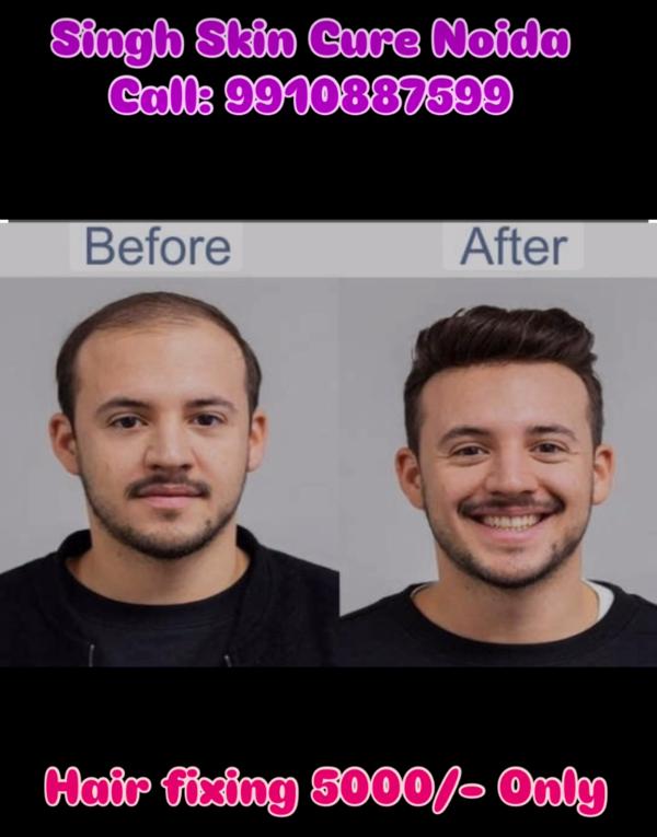 Best hair patch fixing clinic in Noida 
