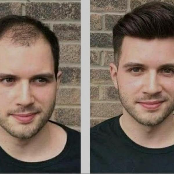 Best hair patch fixing clinic in Noida 
