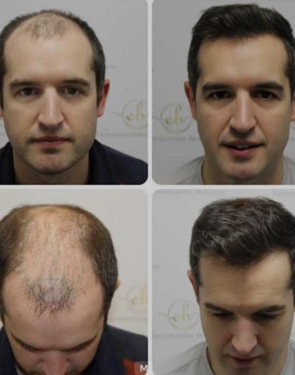 Best hair patch fixing clinic in Noida 
