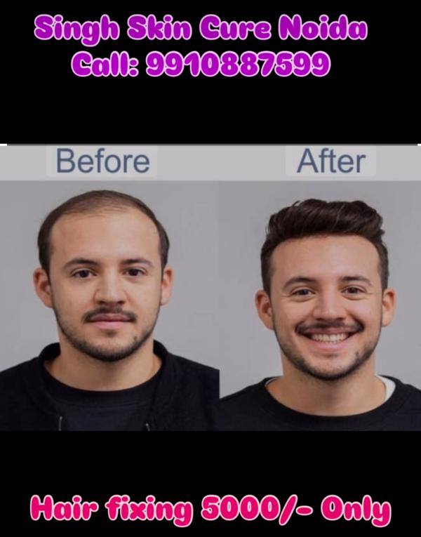 Best hair patch fixing clinic in Noida 
