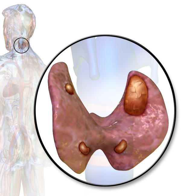 parathyroi
