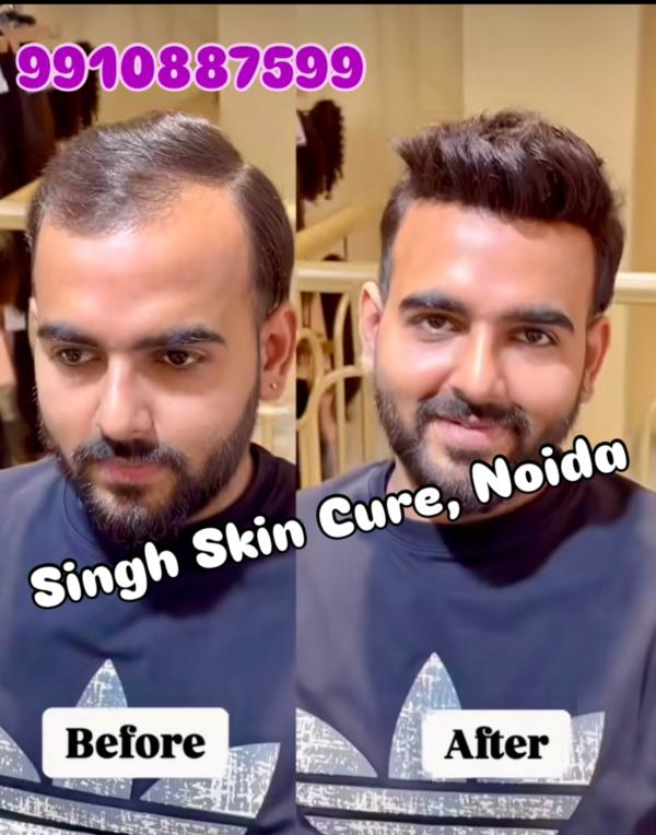 Hair Replacement is a method used to cov