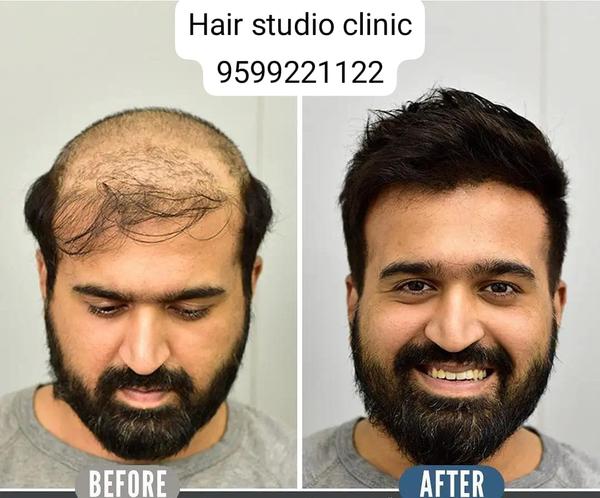 same day hair patch applicatio