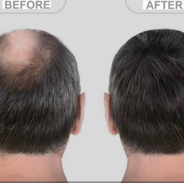 Singh skin cure is the Best hair fixing 