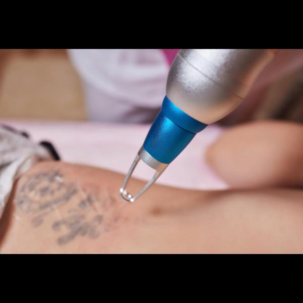 professional tattoo removal st