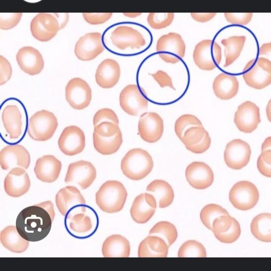 schistocytes rbc fragments dia